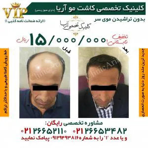 کلینیک تخصصی کاشت مو آریا