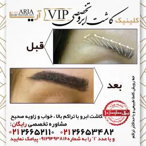 کلینیک فوق تخصصی کاشت ابرو آریا